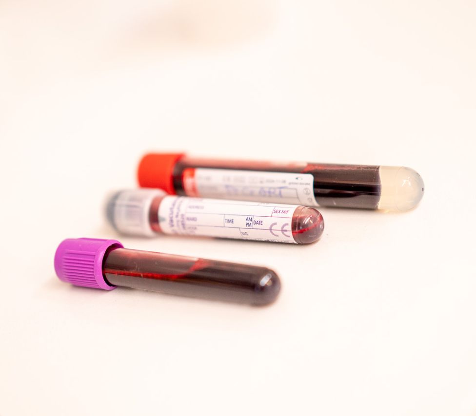 PRP (plaatjes rijk plasma)